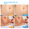 Silicone Gel Sheet Scar Treatment