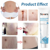 Scar Removal Gel