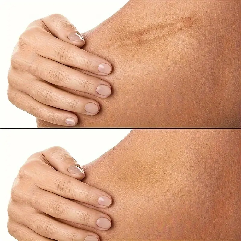 scar away silicone gel (1)