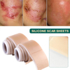 Silicone Scar Patch Removal