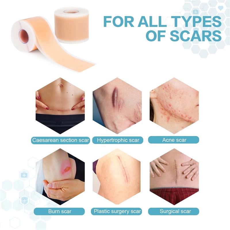 silicone scar removal