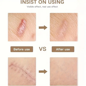 Silicone Gel Sheets for Scars