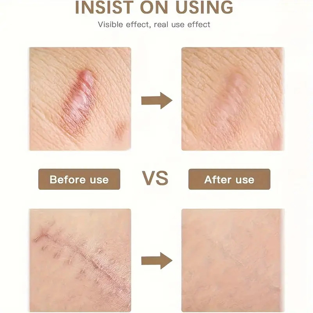 Silicone Gel Sheets for Scars